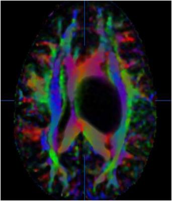 Diffusion Weighted/Tensor Imaging, Functional MRI and Perfusion Weighted Imaging in Glioblastoma—Foundations and Future